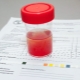 Erythrocytes in the urine of a child