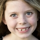 Curved teeth in children