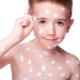 Acyclovir for chickenpox: instructions for use