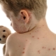 Chickenpox incubation period