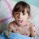 Is it possible to walk a child with chickenpox