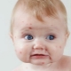 Chicken pox in babies