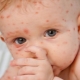 What is chickenpox and how to treat it in children?