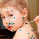 Symptoms, signs and treatment of varicella in children