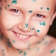 How and what to treat chickenpox at home?