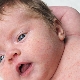 Rubella in infants and newborns