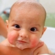 Atopic dermatitis in infants