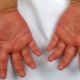 Kawasaki disease in children