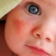 What does dermatitis look like in children?