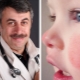 Dr. Komarovsky about red cheeks in a child