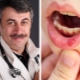 Dr. Komarovsky about stomatitis