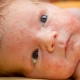 Symptoms and treatment of prickly heat in newborns and infants