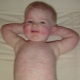 What if there is a rash all over the child’s body, and there is no temperature?