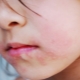 What if there is irritation or a rash around the child’s mouth?