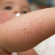 Child rash