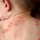 Rash on baby's back