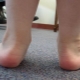 Varus foot deformity in children