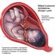 Is it dangerous to entangle the umbilical cord around the neck of the fetus and how does it affect childbirth?