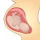 Features of the effect of a short umbilical cord on pregnancy and childbirth