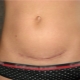 Caesarean scar