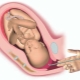 What is amniotomy in childbirth and why do the bubble puncture?