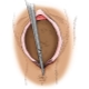 What is perineotomy and when is it used in childbirth?