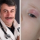 Dr. Komarovsky about the treatment of chalazion in children