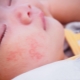 Urticaria in infants: from symptoms to treatment