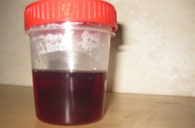 Dark red urine in a child