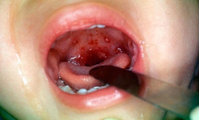 Herpangina in a child