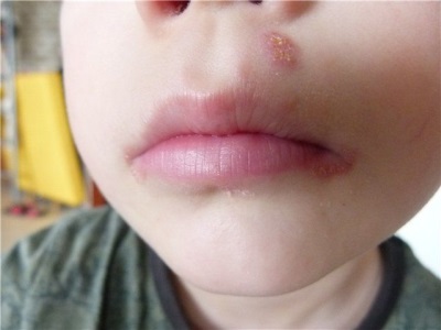 herpes in a child