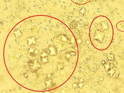 salts of oxalate in the urine