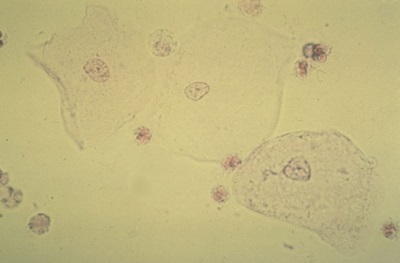 Flat epithelium in the urine of a child