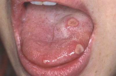 Stomatitis in the tongue