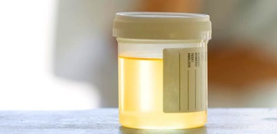 Yellow urine is normal