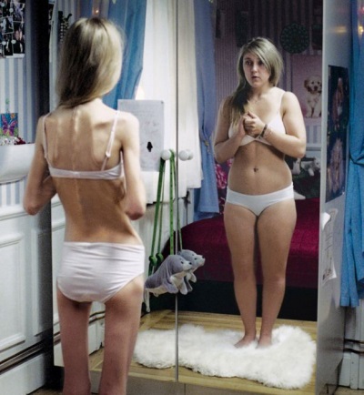 Anorexia in a teenage girl